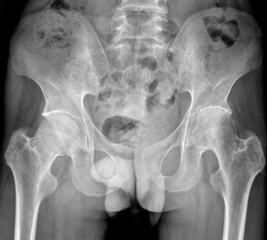 Figure 3 for case Ankylosing spondylitis ( RID3604 )